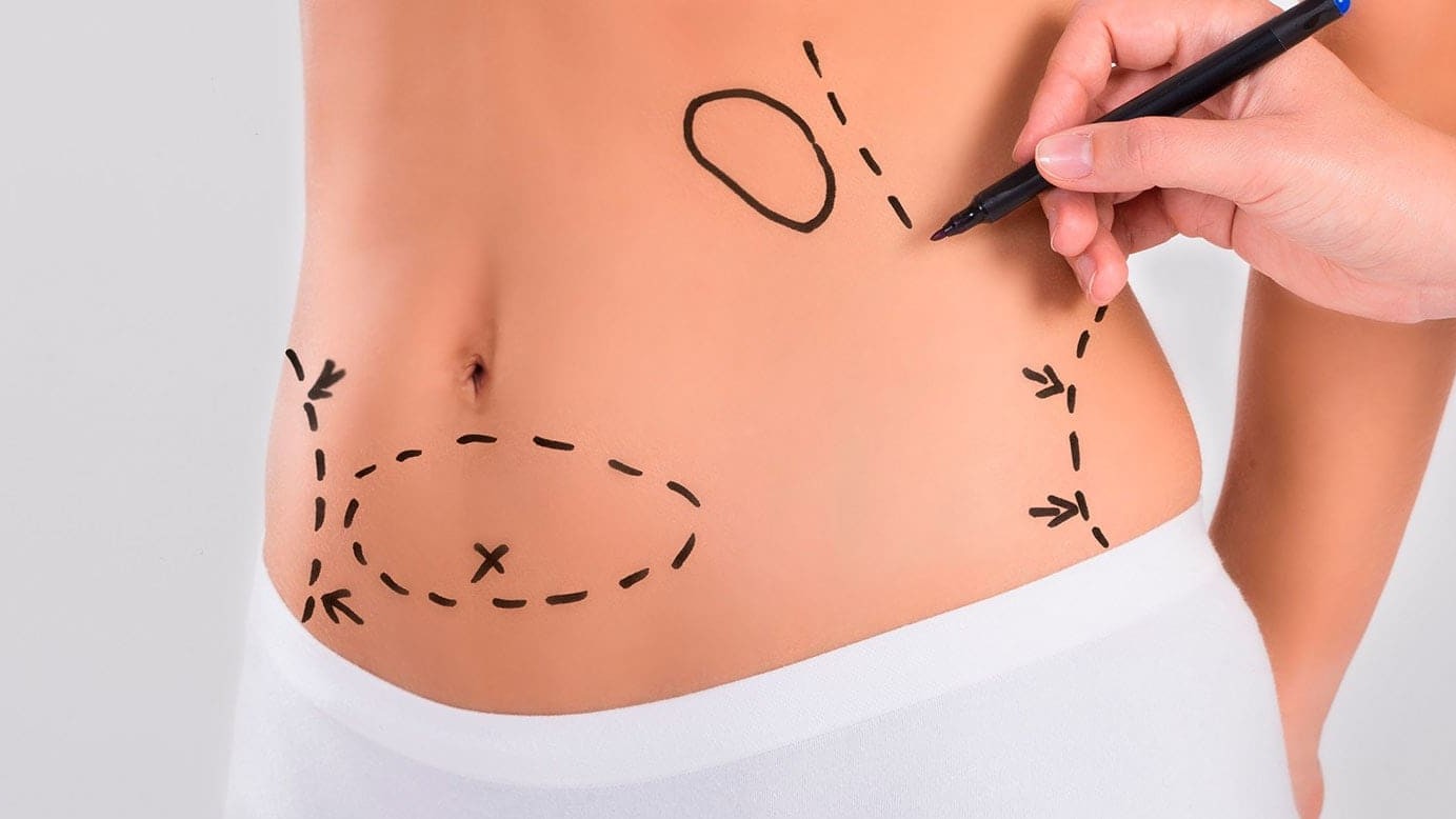 Abdominoplastia