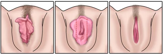 Cirurgia Íntima ou Ninfoplastia