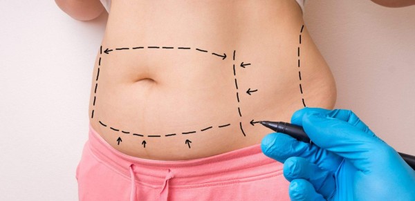 Imagem do procedimento Abdominoplastia